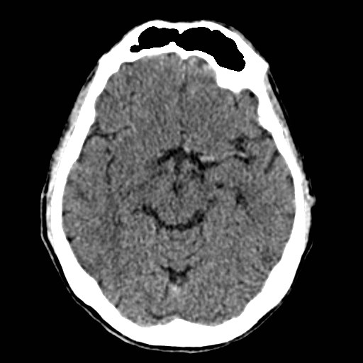 File:Artery of Percheron infarct (Radiopaedia 48088-52893 Axial non-contrast 17).jpg
