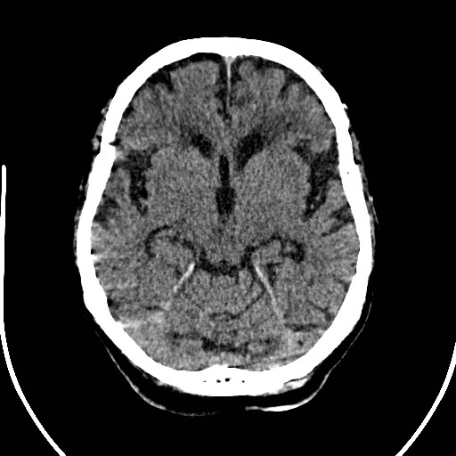 File:Artery of Percheron infarction (Radiopaedia 26307-26438 Axial non-contrast 8).jpg