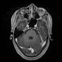 File:Artery of Percheron infarction (Radiopaedia 27975-28230 Axial T1 C+ fat sat 29).jpg