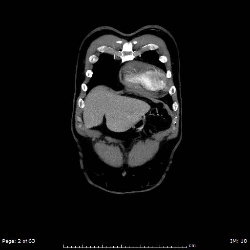 Ascending aortic aneurysm (Radiopaedia 50086-55404 B 2).jpg