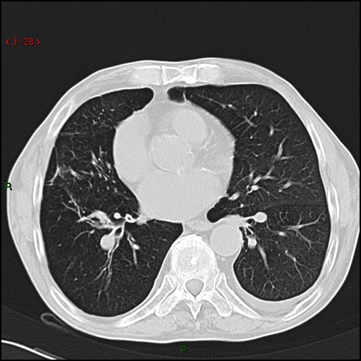File:Aspergilloma (Radiopaedia 14842-14787 Axial lung window 28).jpg