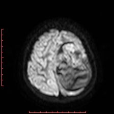 Astroblastoma (Radiopaedia 74287-85162 Axial DWI 89).jpg