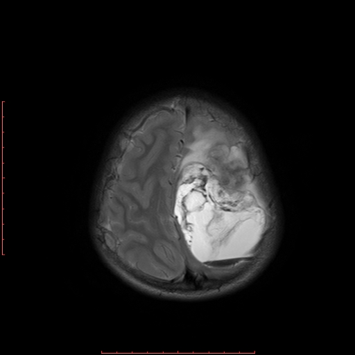 File:Astroblastoma (Radiopaedia 74287-85162 Axial T2 19).jpg