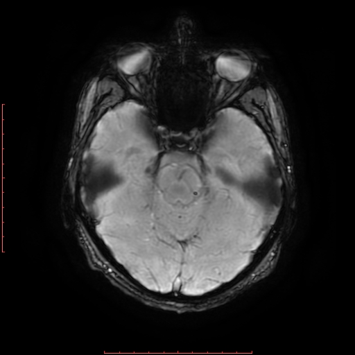 Astrocytoma NOS - cystic (Radiopaedia 59089-66384 Axial SWI 24).jpg