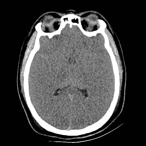 File:Atlanto-occipital dislocation (Radiopaedia 44648-48412 Axial non-contrast 29).jpg