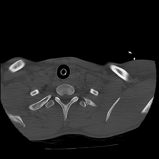 Atlanto-occipital dissociation (Traynelis type 1), C2 teardrop fracture, C6-7 facet joint dislocation (Radiopaedia 87655-104061 Axial bone window 88).jpg