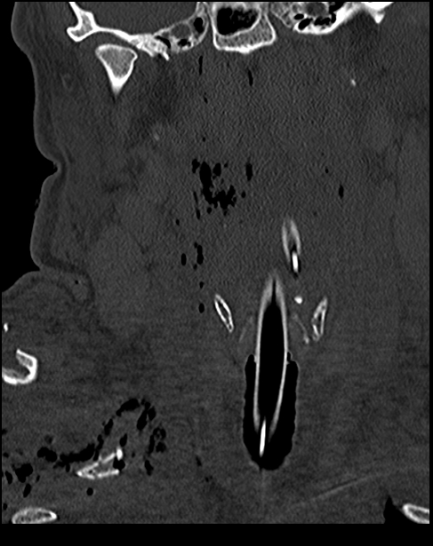 Atlanto-occipital dissociation - Traynelis type 1 (Radiopaedia 87570-103948 Coronal bone window 21).jpg