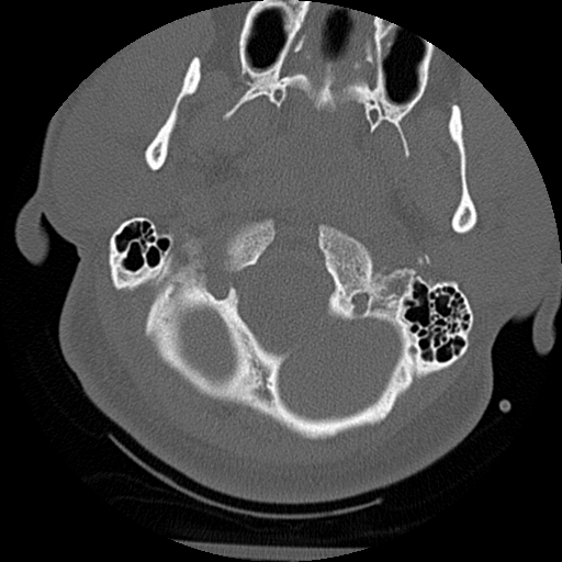 Atlanto-occipital dissociation injury (Radiopaedia 29274-29698 Axial bone window 8).png