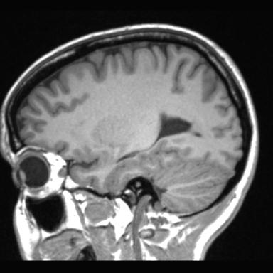 Atretic encephalocoele with inferior vermis hypoplasia (Radiopaedia 30443-31108 Sagittal T1 39).jpg
