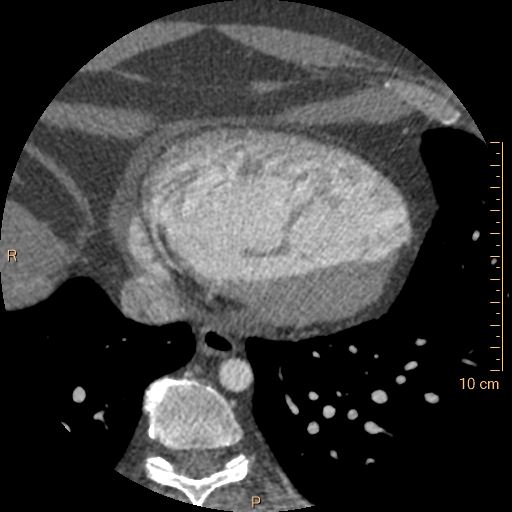 Atrial septal defect (upper sinus venosus type) with partial anomalous pulmonary venous return into superior vena cava (Radiopaedia 73228-83961 A 221).jpg