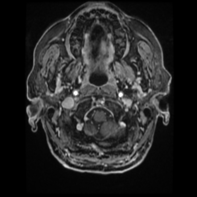 Atypical meningioma (Radiopaedia 45535-49629 Axial T1 C+ 16).jpg