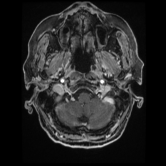 Atypical meningioma (Radiopaedia 45535-49629 Axial T1 C+ 18).jpg