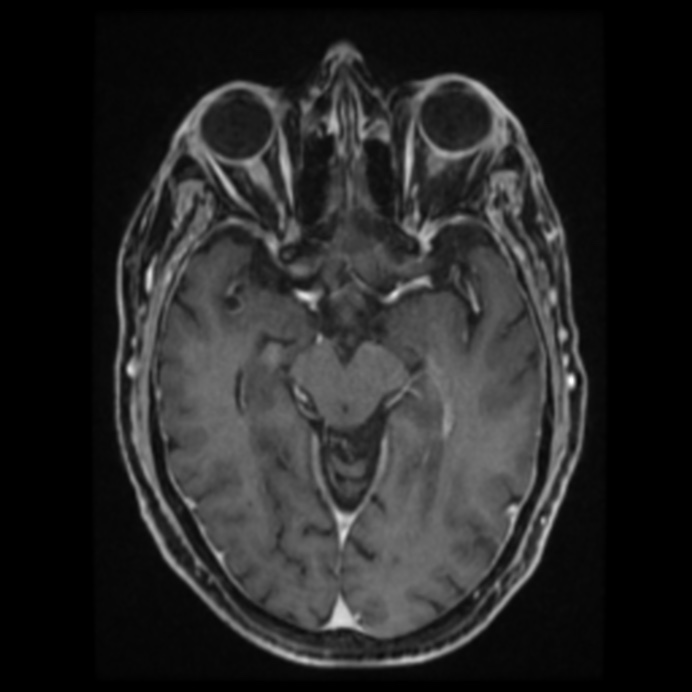 Atypical meningioma (Radiopaedia 45535-49629 Axial T1 C+ 33).jpg