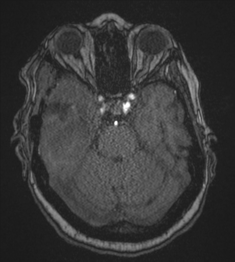 Atypical meningioma (WHO Grade II) (Radiopaedia 54742-60981 Axial MRA 32).png