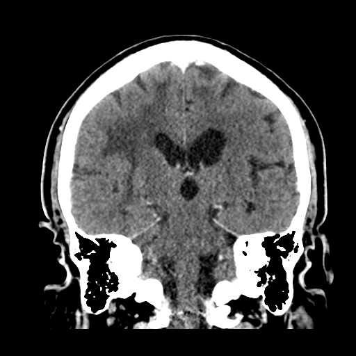 Atypical meningioma (WHO grade II) with brain invasion (Radiopaedia 57767-64728 Coronal C+ 37).png