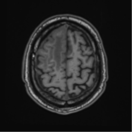 File:Atypical meningioma (WHO grade II) with brain invasion (Radiopaedia 57767-64729 Axial T1 43).png