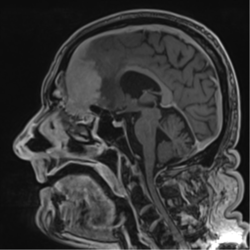 Atypical meningioma (WHO grade II) with brain invasion (Radiopaedia 57767-64729 Sagittal T1 C+ 37).png