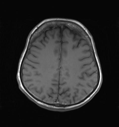 File:Autoimmune limbic encephalitis (Radiopaedia 30363-31005 Axial T1 23).jpg