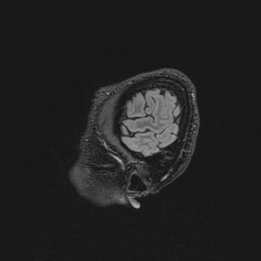 Autoimmune limbic encephalitis (Radiopaedia 30363-31005 Sagittal FLAIR 20).jpg