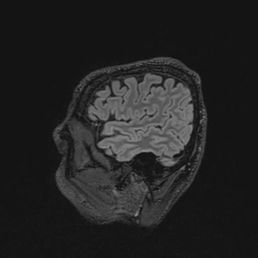 Autoimmune limbic encephalitis (Radiopaedia 30363-31005 Sagittal FLAIR 31).jpg