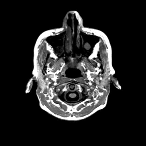 Autoimmune limbic encephalitis (Radiopaedia 30363-31005 T1 Axial 1mm 8).jpg