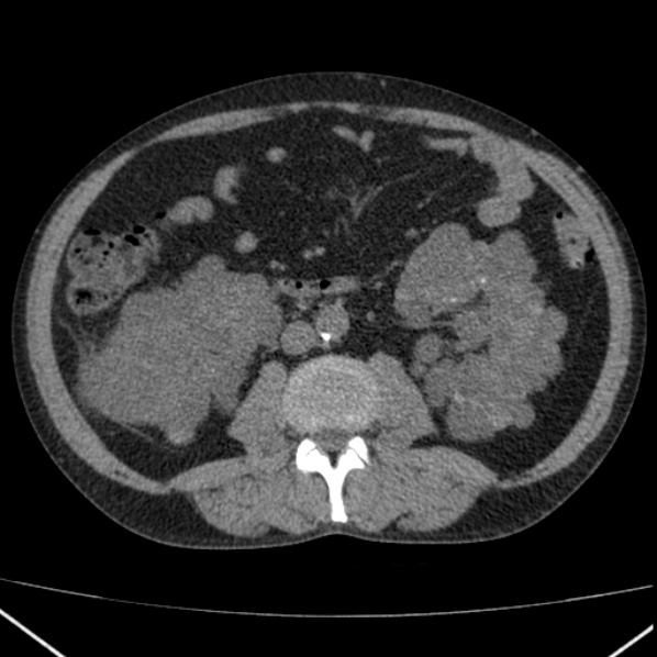 File:Autosomal dominant polycystic kidney disease (Radiopaedia 36539-38101 Axial non-contrast 45).jpg