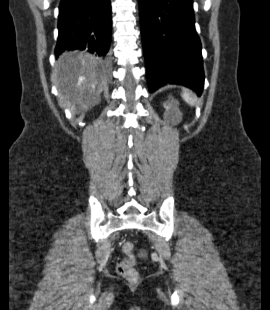 Autosomal dominant polycystic kidney disease (Radiopaedia 57124-64017 B 63).jpg