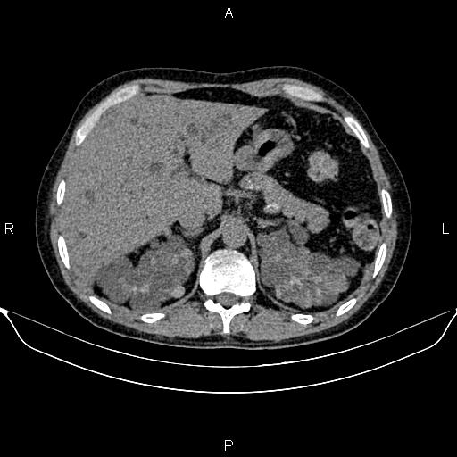 Autosomal dominant polycystic kidney disease (Radiopaedia 87830-104287 Axial non-contrast 15).jpg