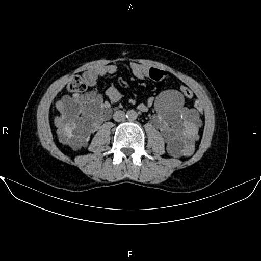 Autosomal dominant polycystic kidney disease (Radiopaedia 87830-104287 Axial non-contrast 30).jpg