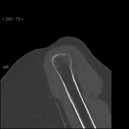 Avascular necrosis of the shoulder - Cruess stage I (Radiopaedia 77674-89887 Sagittal bone window 78).jpg