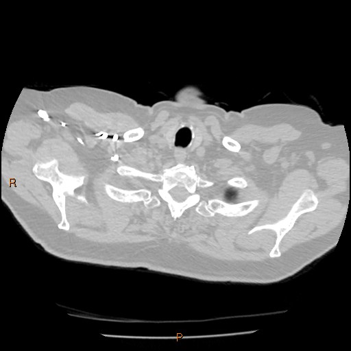 Azygos lobe (Radiopaedia 40161-42821 Axial lung window 1).jpg