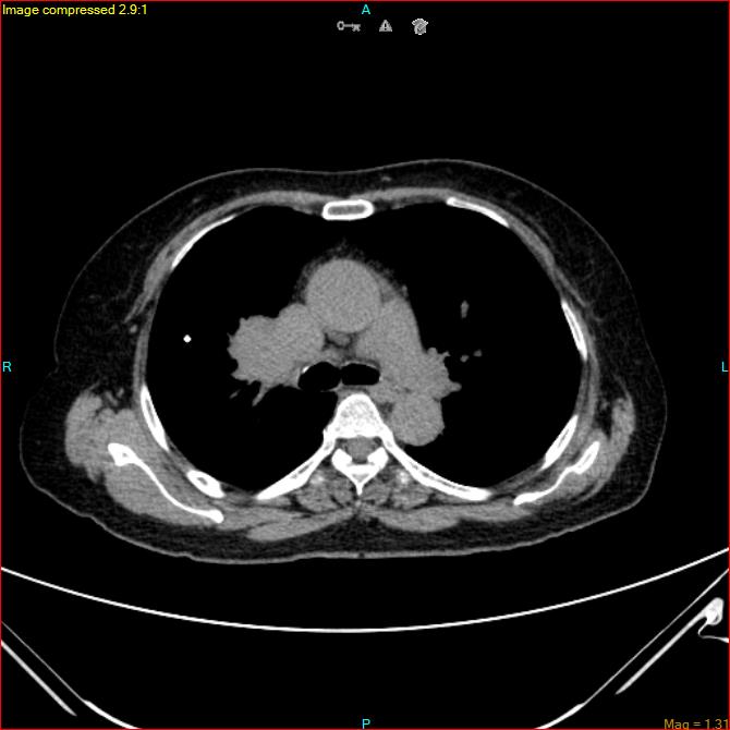 Azygos vein aneurysm (Radiopaedia 77824-90130 A 26).jpg