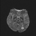 Balo concentric sclerosis (Radiopaedia 50458-55940 Axial DWI 35).jpg