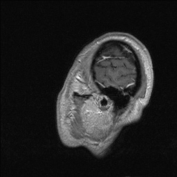 Balo concentric sclerosis (Radiopaedia 50458-55940 Sagittal T1 C+ 139).jpg