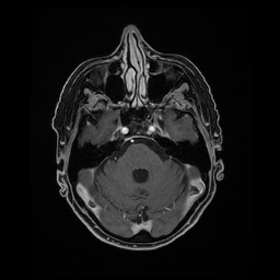 Balo concentric sclerosis (Radiopaedia 53875-59982 Axial LAVA C+ 76).jpg