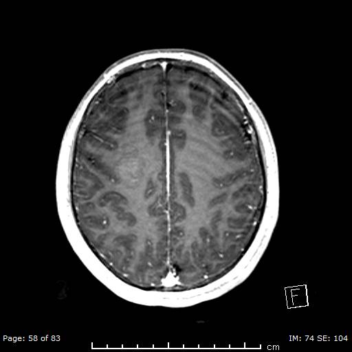 Balo concentric sclerosis (Radiopaedia 61637-69636 Axial T1 C+ 58).jpg