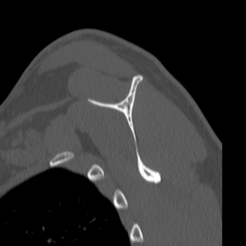 Bankart lesion (Radiopaedia 57256-64185 Sagittal bone window 46).jpg