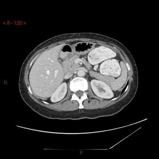 Bartholin gland cyst (Radiopaedia 54904-61181 A 30).jpg
