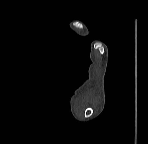 Base of 2nd metacarpal fracture (Radiopaedia 73741-84544 Sagittal bone window 84).jpg