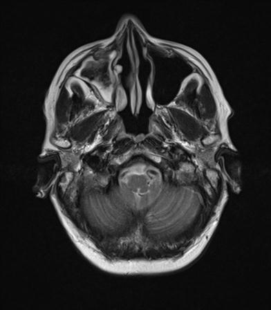 File:Base of skull chondrosarcoma (Radiopaedia 30410-31070 Axial T2 3).jpg