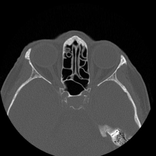 File:Base of skull chondrosarcoma (Radiopaedia 30410-31071 Axial bone window 28).jpg