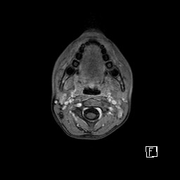 Base of skull rhabdomyosarcoma (Radiopaedia 32196-33142 T1 C+ fat sat 11).jpg