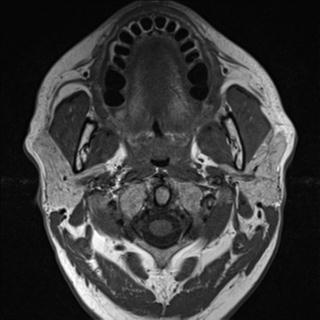 File:Base of tongue squamous cell carcinoma (Radiopaedia 31174-31884 Axial T1 27).jpg