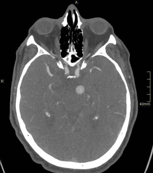 File:Basilar artery aneurysm (Radiopaedia 56261-62932 A 72).jpg