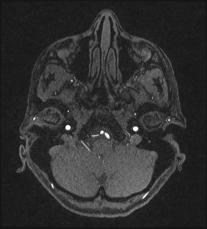 Basilar artery perforator aneurysm (Radiopaedia 82455-97733 Axial MRA 44).jpg