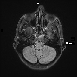 File:Basilar artery perforator aneurysm (Radiopaedia 82455-99523 Axial FLAIR 5).jpg