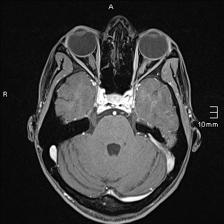 Basilar artery perforator aneurysm (Radiopaedia 82455-99523 G 39).jpg