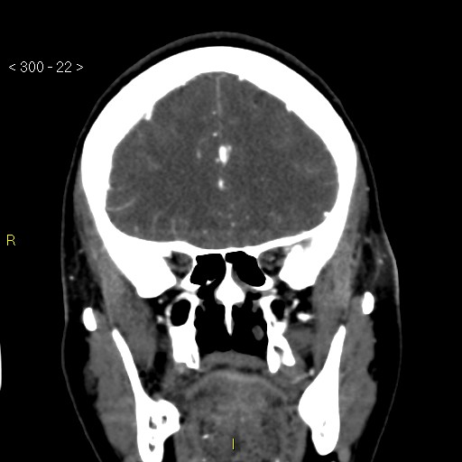 File:Basilar artery thrombosis (Radiopaedia 16260-15944 B 13).jpg