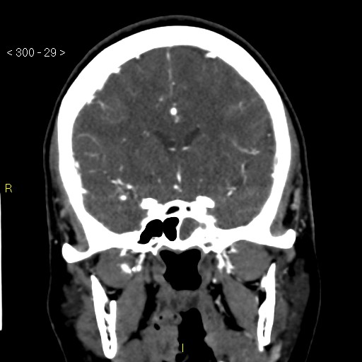 File:Basilar artery thrombosis (Radiopaedia 16260-15944 B 20).jpg