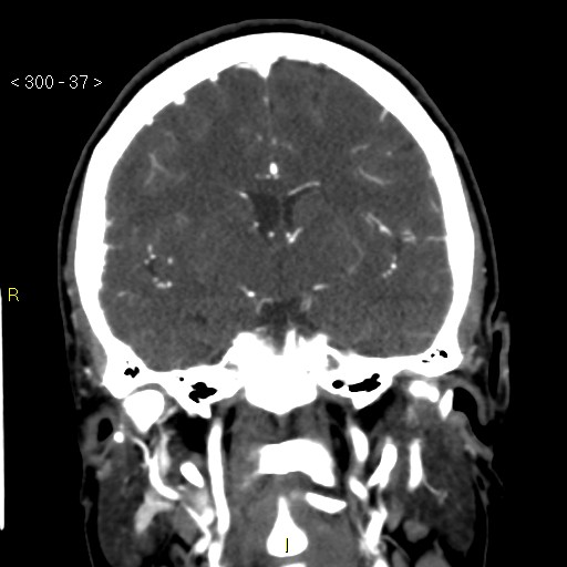 Basilar artery thrombosis (Radiopaedia 16260-15944 B 28).jpg